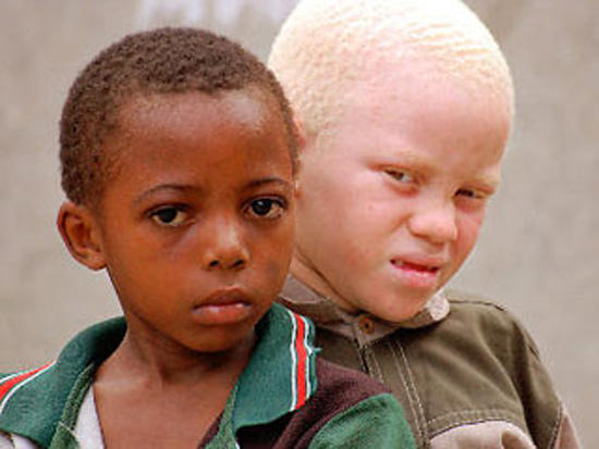 Африканский мальчик-альбинос